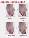 Hallux valgus ervaringen
