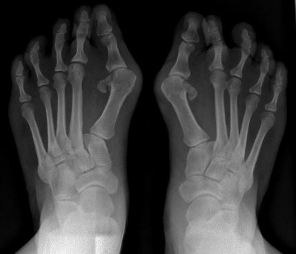 ernstige hallux valgus