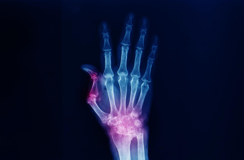 waarom helpt een brace bij artrose in het duimgewricht