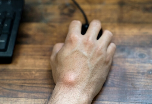 ganglion