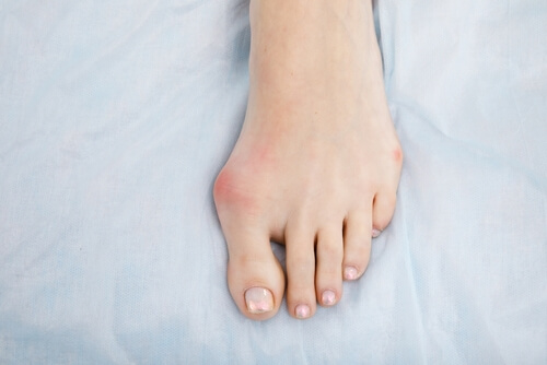 hallux valgus