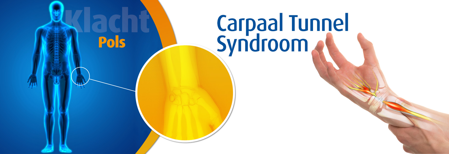 Carpaal tunnel Wat het? | Podobrace.nl